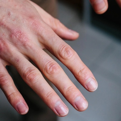 Why Do Hands Sometimes Become Drier Than Usual?