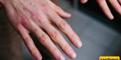 Why Do Hands Sometimes Become Drier Than Usual?