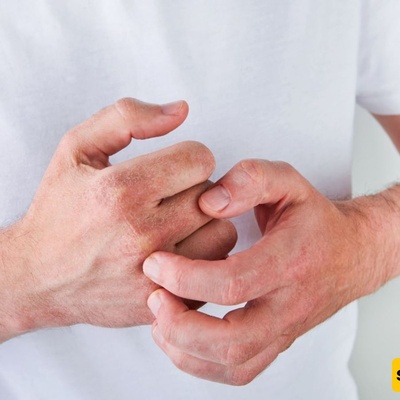 10 Best Natural Oils for Eczema Relief and Skin Care