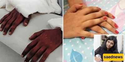Doctors Astonished as Man's Hands Take on Feminine Features After Transplant to 18-Year-Old Girl
