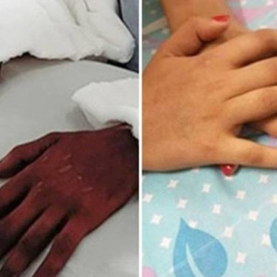 Doctors Astonished as Man's Hands Take on Feminine Features After Transplant to 18-Year-Old Girl