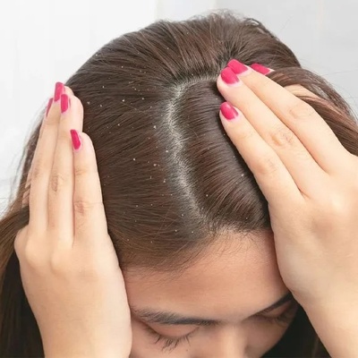 Does Hot Water Cause Dandruff?