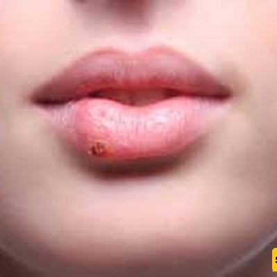 The Scientific Link Between Cold Sores and Alzheimer’s Disease Onset