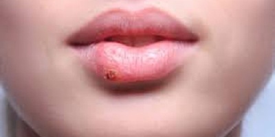 The Scientific Link Between Cold Sores and Alzheimer’s Disease Onset