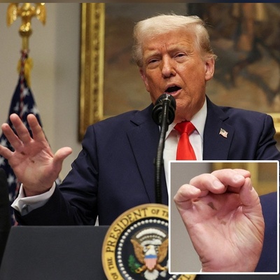 Never-Ending Trump Controversies at 79: Clumsy Use of Melania’s Foundation to Cover a Bruise on His Hand! +Photo