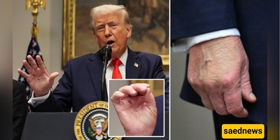 Never-Ending Trump Controversies at 79: Clumsy Use of Melania’s Foundation to Cover a Bruise on His Hand! +Photo
