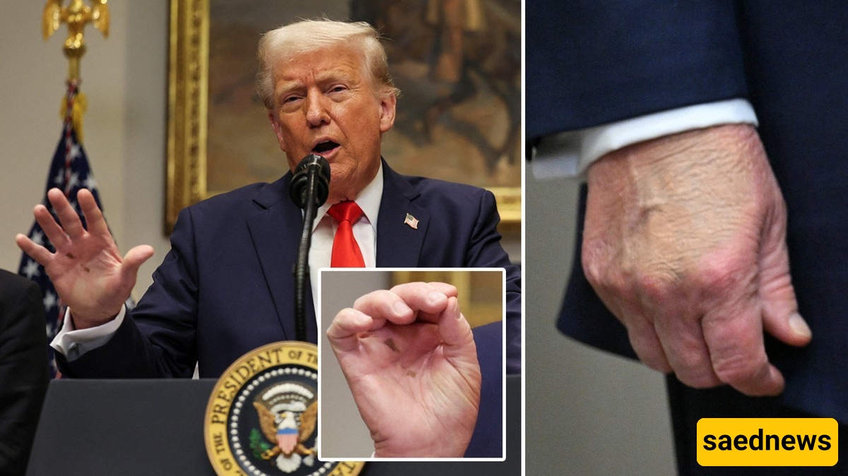 Never-Ending Trump Controversies at 79: Clumsy Use of Melania’s Foundation to Cover a Bruise on His Hand! +Photo