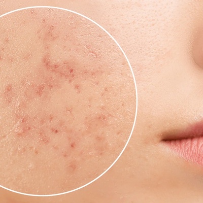 5 Ways to Prevent Pimples After Facial Threading
