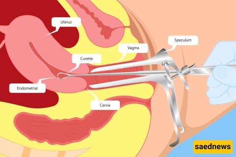 What is D&C (Curettage)?
