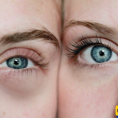 What Is The Meaning of Puffiness Around The Eyes?