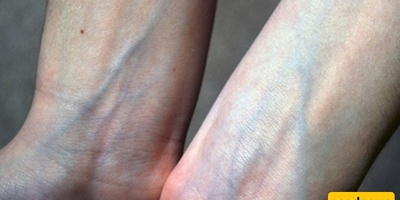 Why Are Veins Blue While Blood Is Red?
