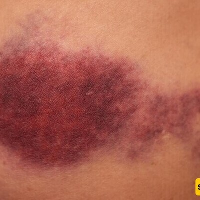 The Main Causes of Bruising in the Body / Bruising: From a Simple Blue Spot to a Sign of Dangerous Diseases!