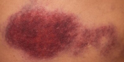 The Main Causes of Bruising in the Body / Bruising: From a Simple Blue Spot to a Sign of Dangerous Diseases!