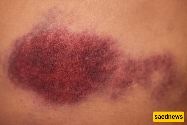 The Main Causes of Bruising in the Body / Bruising: From a Simple Blue Spot to a Sign of Dangerous Diseases!