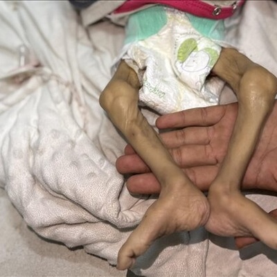 Another Palestinian Infant Dies From Malnutrition In Gaza