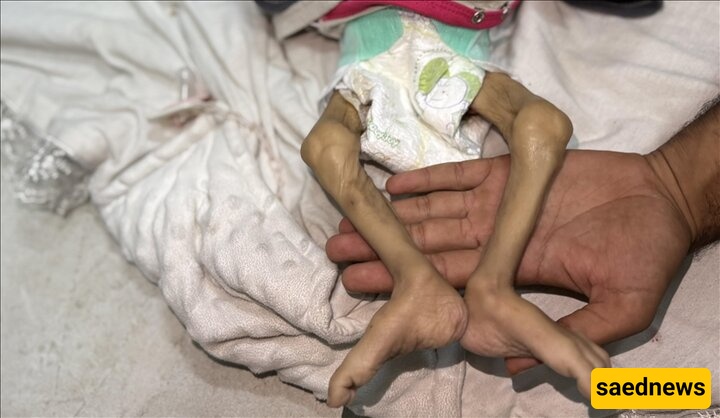 Another Palestinian Infant Dies From Malnutrition In Gaza