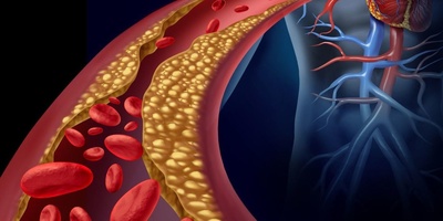 High Cholesterol, The “Silent Killer”: A Guide To Diagnosing And Managing Blood Lipids
