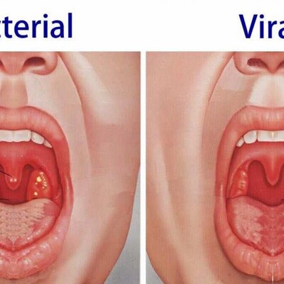 10 Effective Home Remedies for Uvula Swelling (Uvulitis) + Key Tips