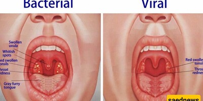 10 Effective Home Remedies for Uvula Swelling (Uvulitis) + Key Tips