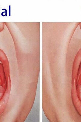 10 Effective Home Remedies for Uvula Swelling (Uvulitis) + Key Tips