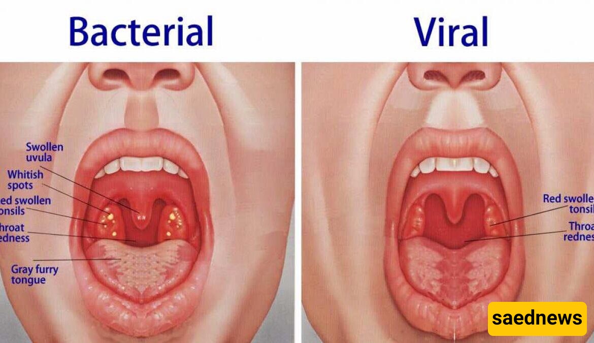 10 Effective Home Remedies for Uvula Swelling (Uvulitis) + Key Tips