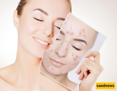 10 Most Effective Home Remedies for Acne Removal