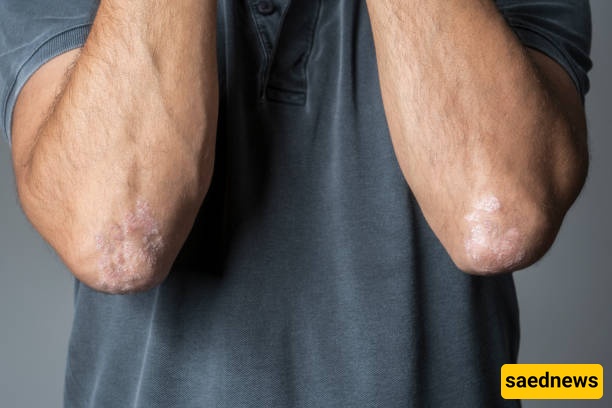 elbows