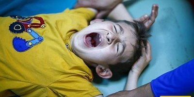 What Is the Best Time and Method for Circumcising Boys?