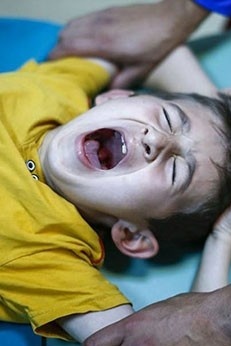 What Is the Best Time and Method for Circumcising Boys?