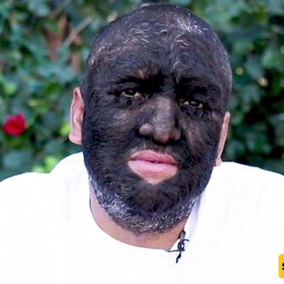 The Man Whose Body Is Covered by 98% Hair