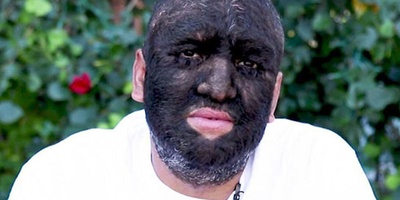 The Man Whose Body Is Covered by 98% Hair
