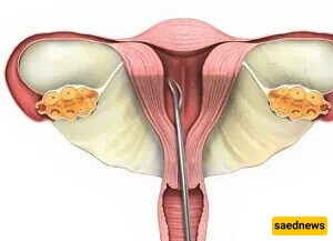 What is D&C (Curettage)?