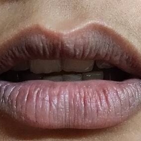 What Causes Darkening Around The Lips And What Are The Treatment Options?