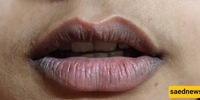 What Causes Darkening Around The Lips And What Are The Treatment Options?