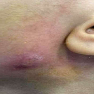 How to Remove a Worm from an 8-Year-Old’s Face (With Photos)