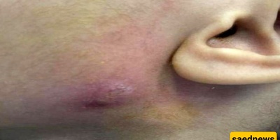 How to Remove a Worm from an 8-Year-Old’s Face (With Photos)