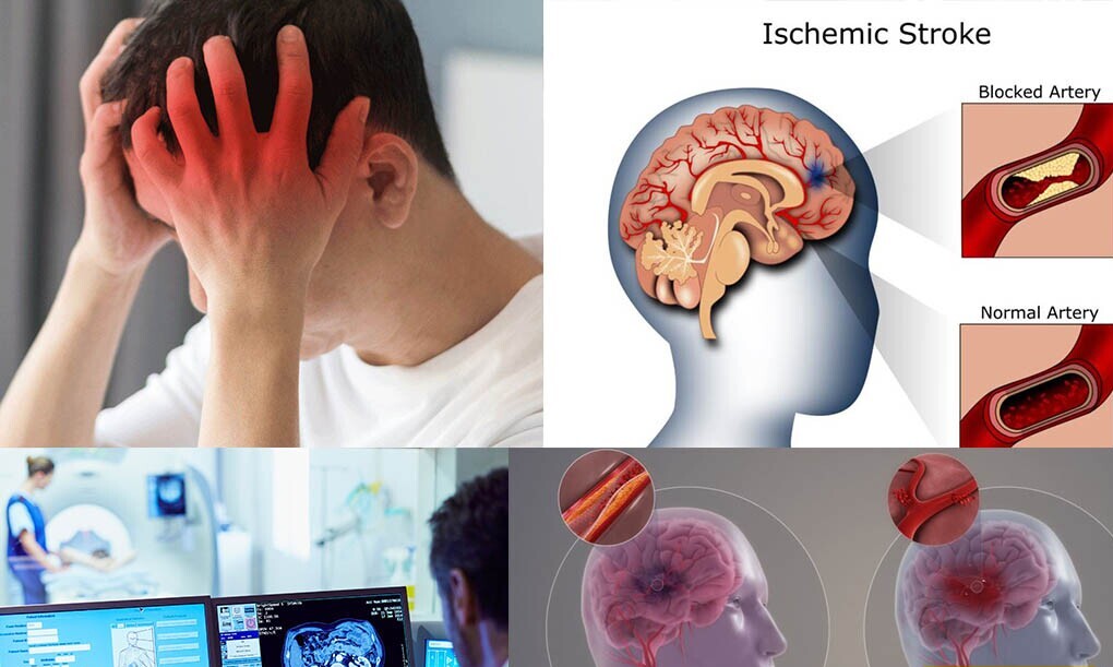 Stroke: The Second Leading Cause of Death Among Iranians / Alarm Bell as the Average Age of Strokes in Iran Drops by 10 Years