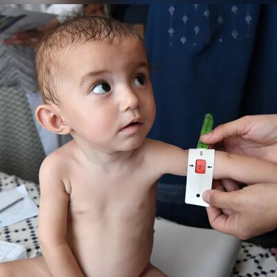 UNICEF Sounds Alarm on Malnutrition Crisis in West Asia : 77 Milion Children Suffering From Malnutrition