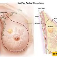 Everything About Breast Cysts in Women: Symptoms, Causes, and Simple Treatment and Home Care Methods