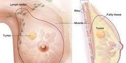 Everything About Breast Cysts in Women: Symptoms, Causes, and Simple Treatment and Home Care Methods