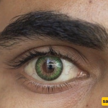 Hidden Complications of Eye Color Change with Iris Implants (Lens Implant Surgery)