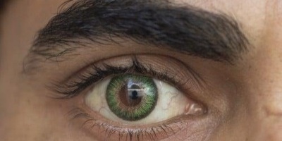 Hidden Complications of Eye Color Change with Iris Implants (Lens Implant Surgery)