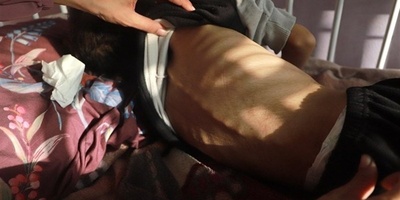 UNICEF Warns Gaza Child Malnutrition Soars Amid Israeli Aid Restrictions