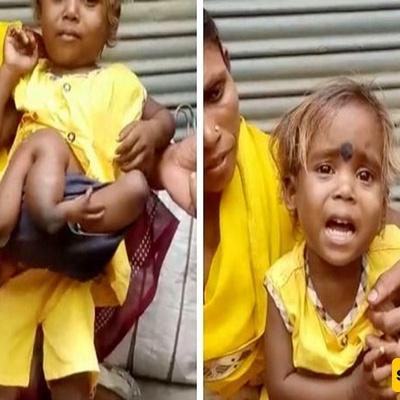 The “Spider Girl” Who Has Two Extra Pairs Of Arms And Legs