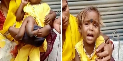 The “Spider Girl” Who Has Two Extra Pairs Of Arms And Legs